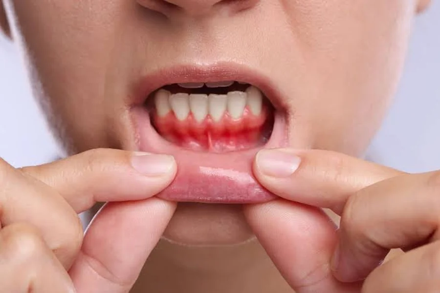 3 Signs You Should Ask Your General Dentist About Gum Health Dentist
